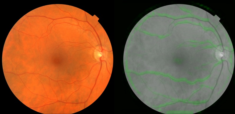 IA da Google pode prevenir doenças cardíacas apenas examinando seus olhos IA da Google pode prevenir doenças cardíacas apenas examinando seus olhos